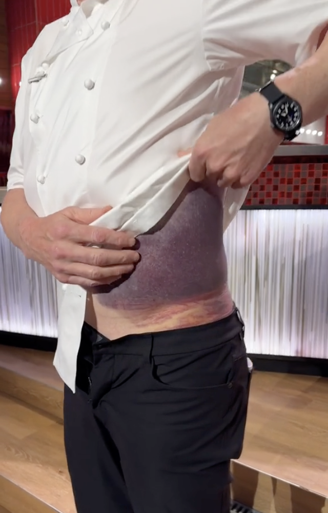 Gordon Ramsay a eu un grave accident et ses blessures donnent des frissons 