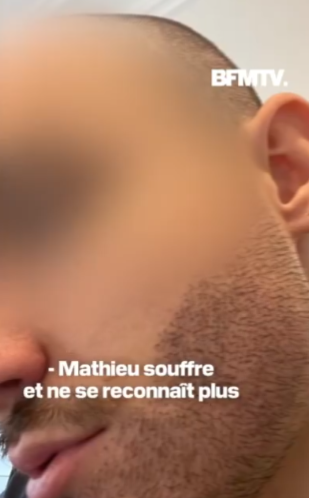 Un jeune homme met fin à ses jours à la suite d'une greffe de la barbe ratée 