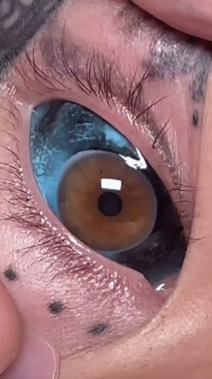 Une femme qui avait perdu la vue à la suite d'un tatouage dans l'oeil se fait tatouer à nouveau au même endroit.