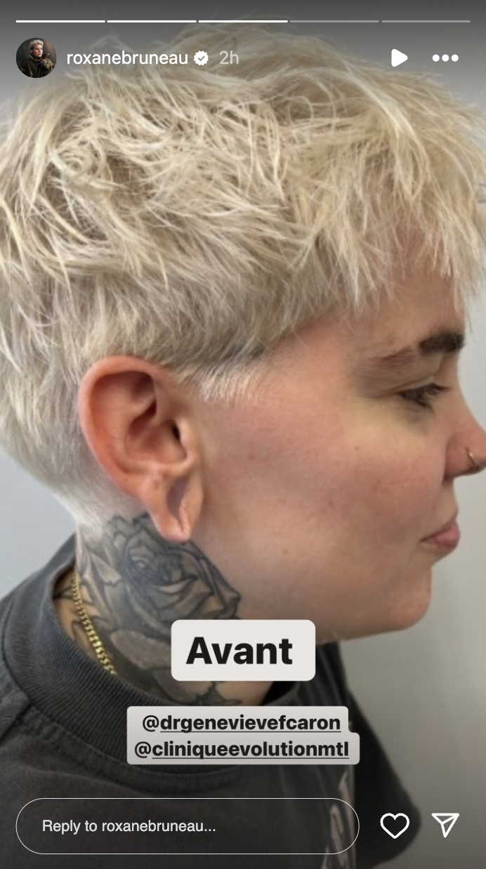 Roxane Bruneau partage le résultat de son opération aux oreilles