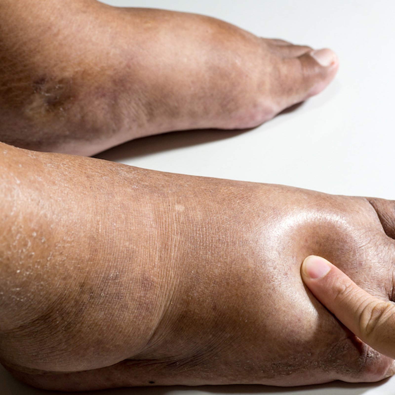 4 astuces pour  soulager les pieds gonflés  par la chaleur