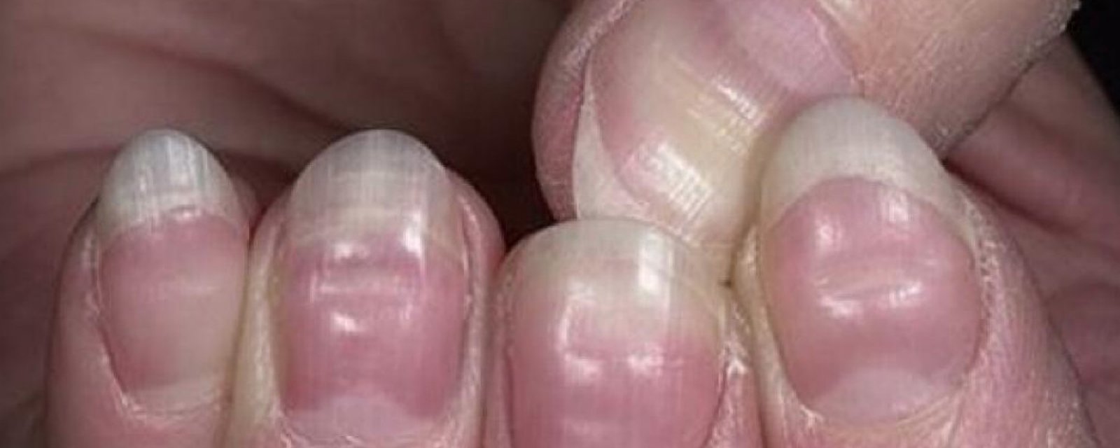 Si vous remarquez ça sur vos ongles, vous devriez consulter un médecin!