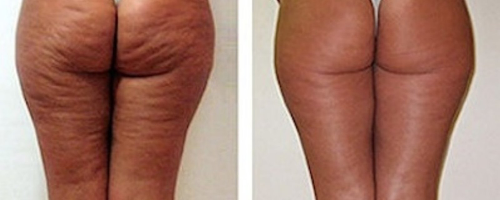 Ce qu’elle a utilisé pour faire disparaître sa cellulite se trouve probablement dans votre… poubelle!