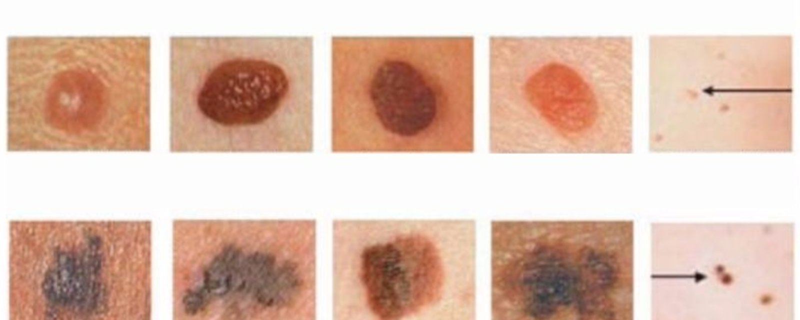 Ce détecteur de cancer de la peau pourrait vous sauver la vie ou celle d’un proche!