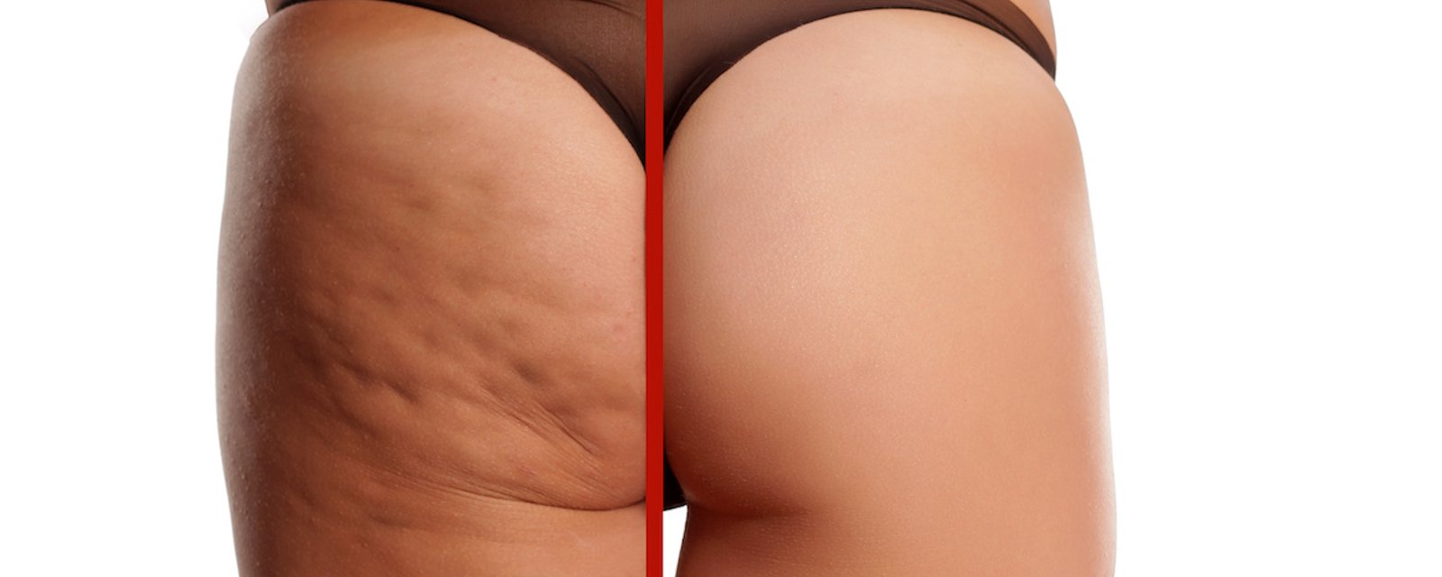 7 aliments qui peuvent vous aider à combattre la cellulite