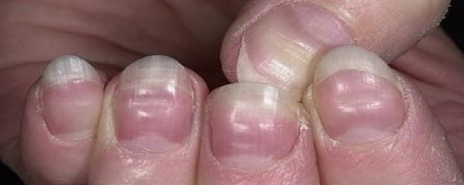 Vos ongles sont très révélateurs de votre état de santé : 15 signes à ne pas prendre à la légère
