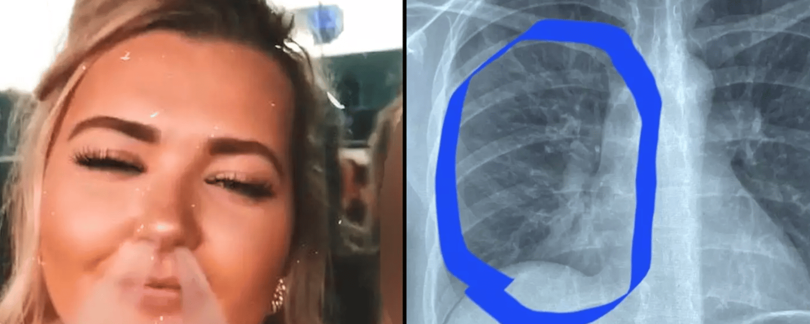 Une jeune femme apprend qu'elle a les poumons d'une personne de 80 ans à cause du vapotage.