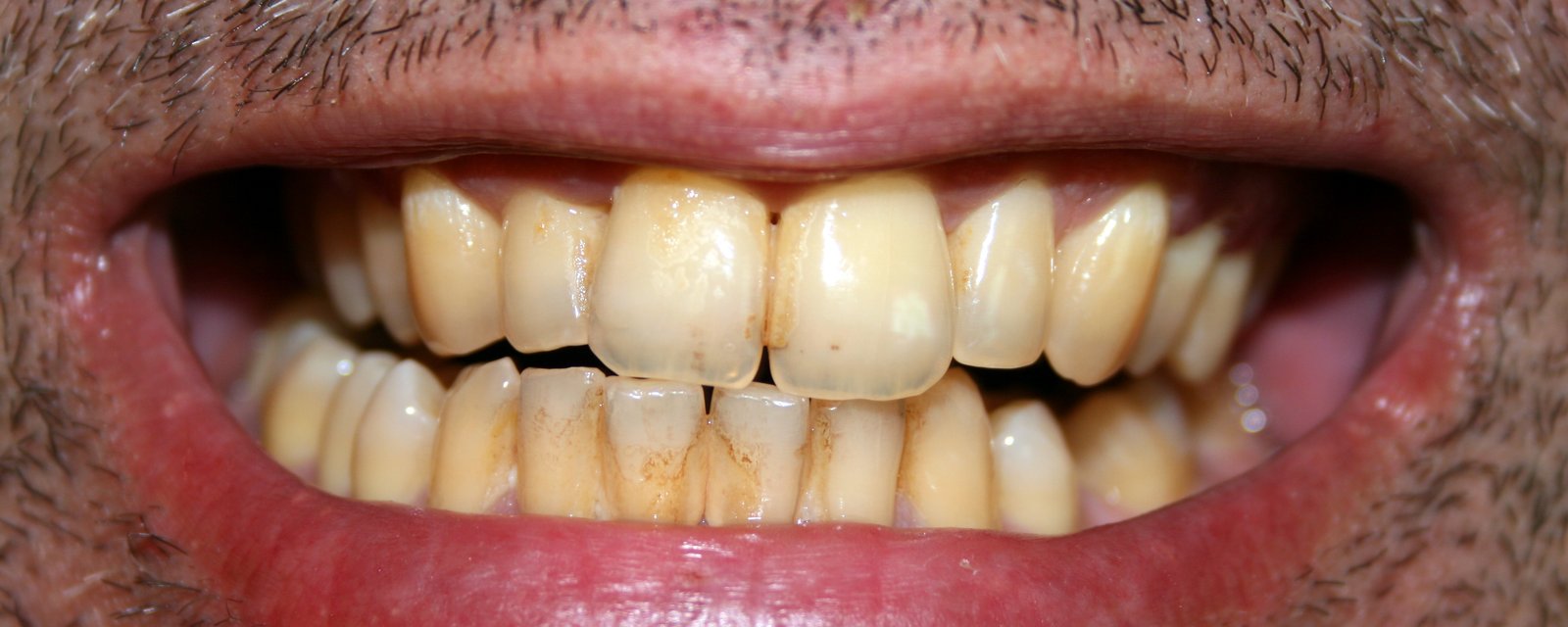 Une dentiste dévoile trois choses à éviter afin que vos dents ne jaunissent pas.