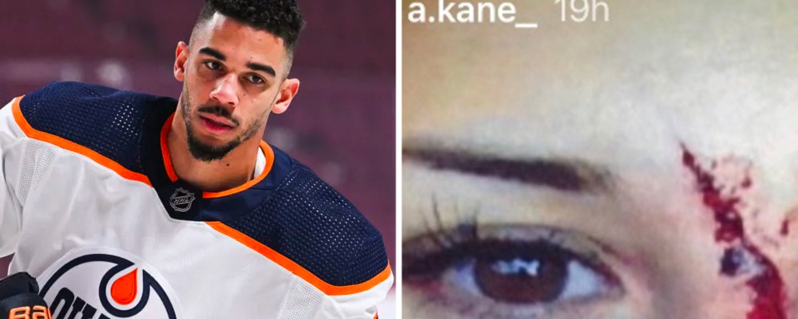 Evander Kane's ex-wife Anna releases disturbing photos, accuses Evander of domestic abuse