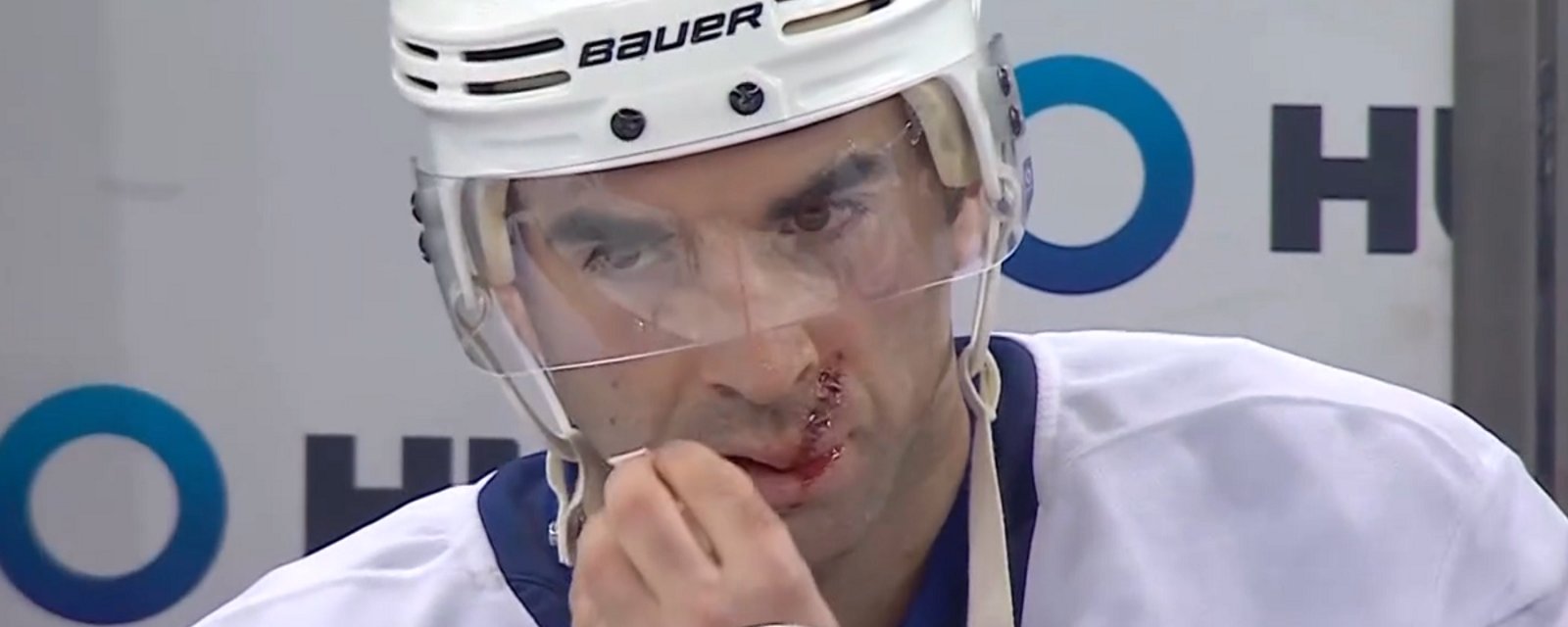 Kyle Palmieri suffers a nasty looking injury on Sunday.