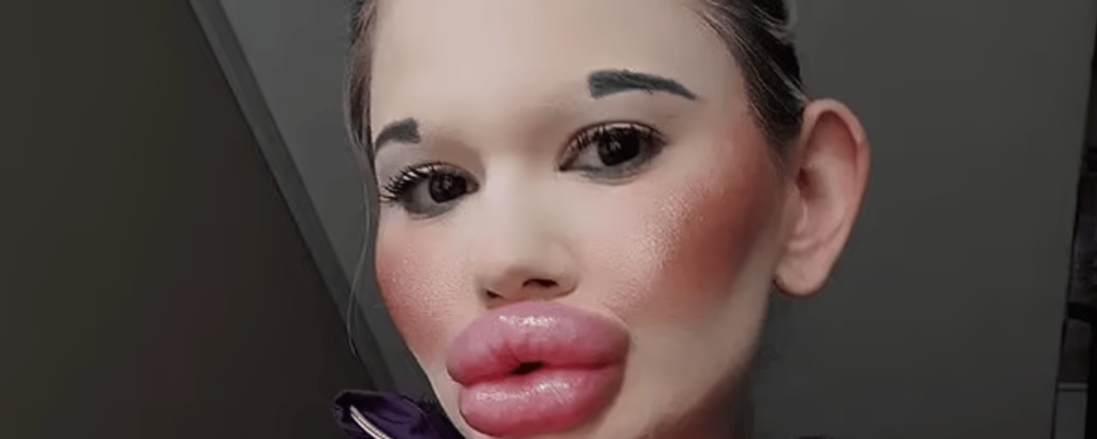 La femme aux plus grosses lèvres du monde veut désormais les pommettes les plus imposantes
