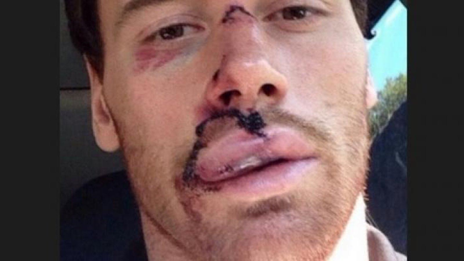 Photo: Le visage de Martin Havlat méconnaissable suite à une mise en échec