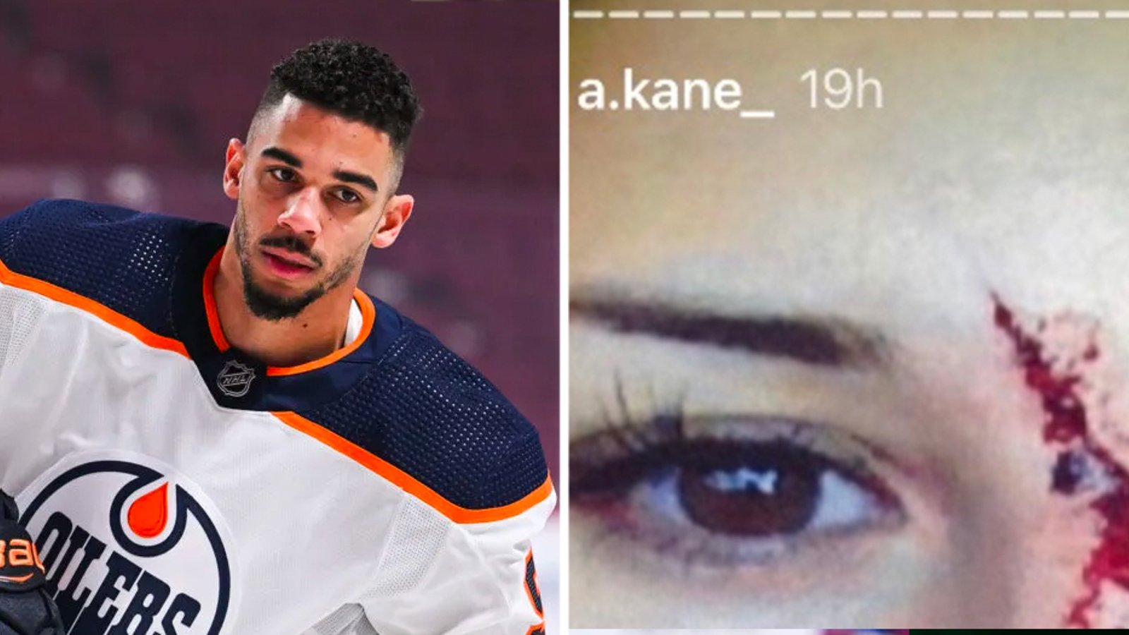Evander Kane's ex-wife Anna releases disturbing photos, accuses Evander of domestic abuse