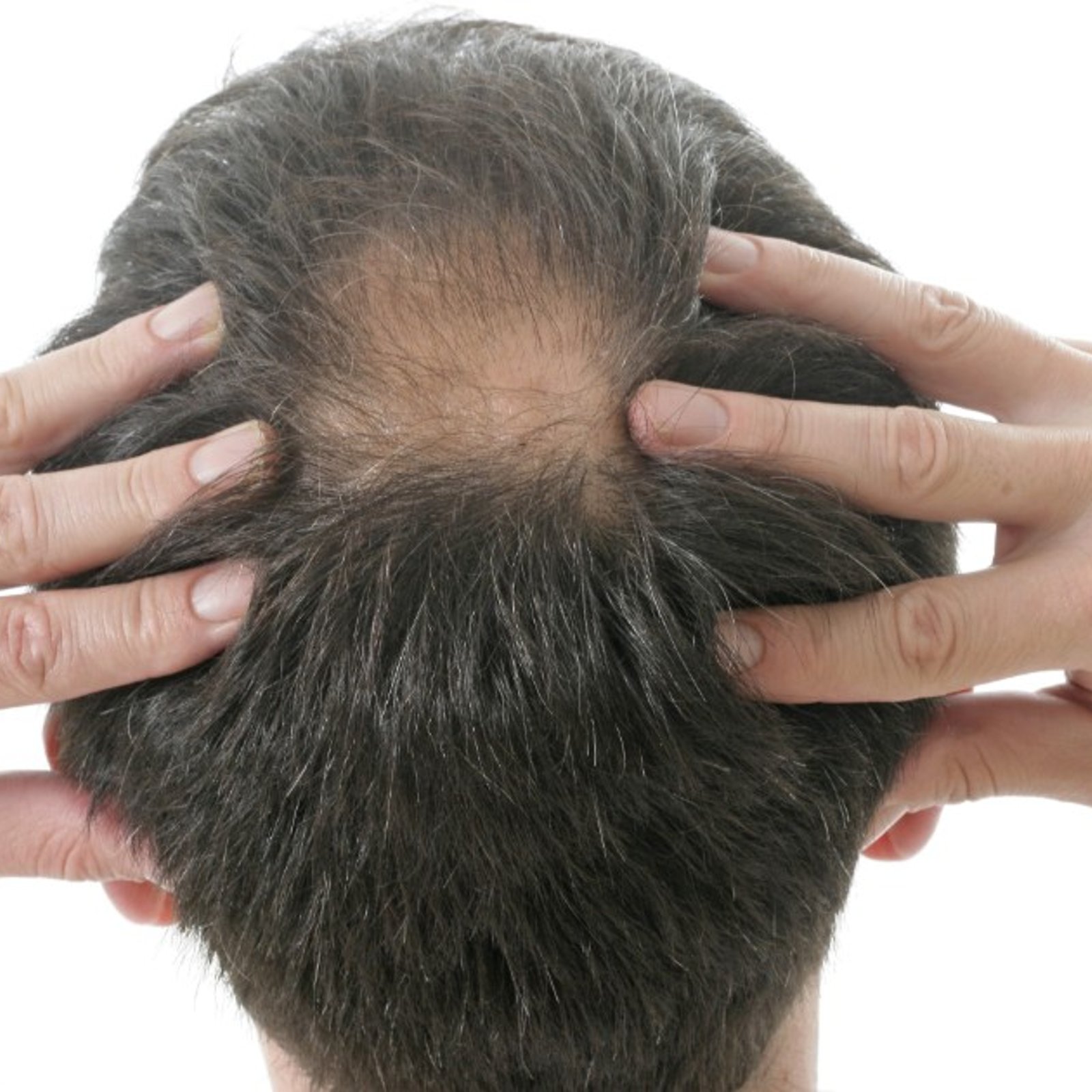Des chercheurs développent un traitement pour éviter la perte des cheveux