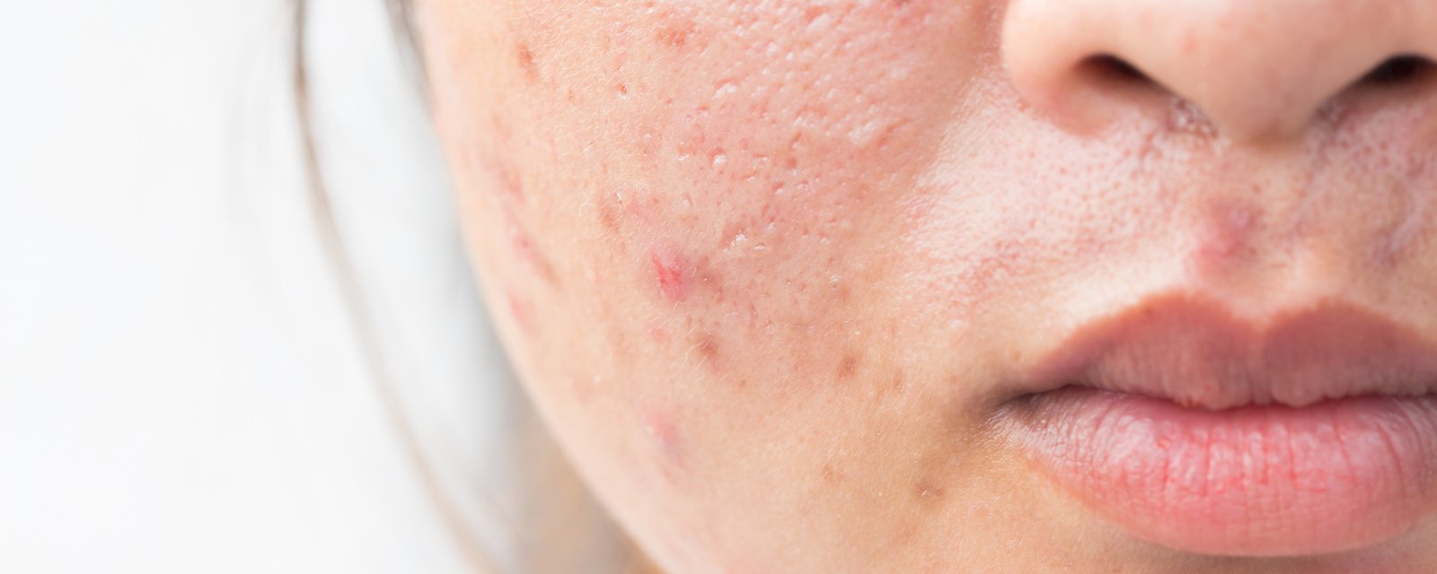 7 mythes sur l'acné auxquels vous devez cesser de croire!