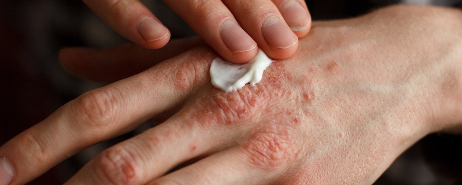 10 remèdes naturels contre la peau sèche