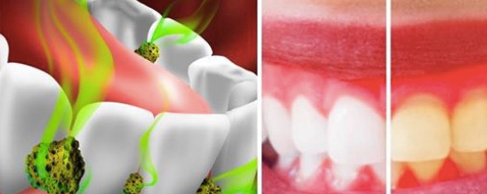 7 façons de tuer les bactéries dans votre bouche et de combattre la mauvaise haleine 