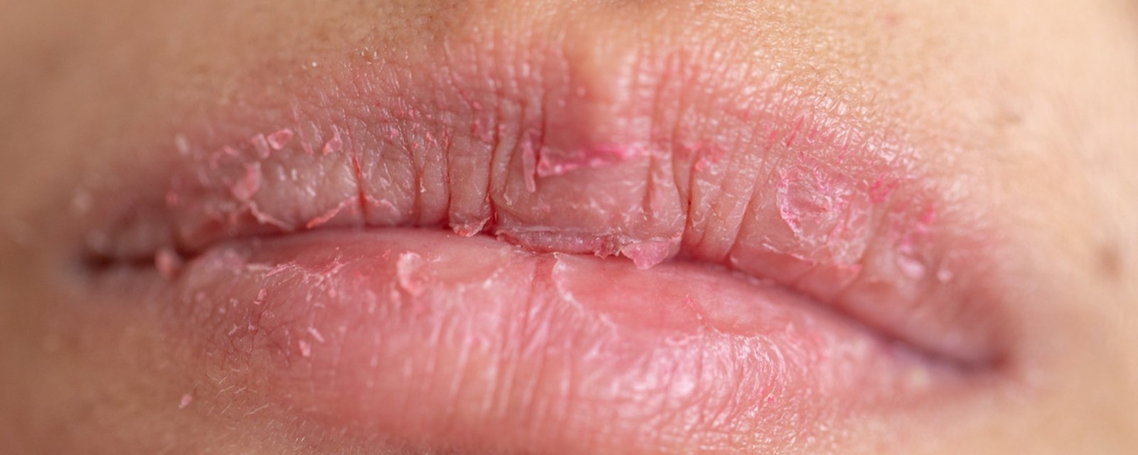 Lèvres gercées: 5 choses à ne pas faire