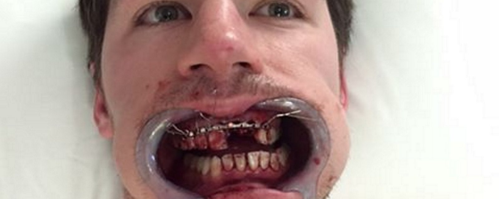 Breaking: Logan Couture shows gruesome pictures of his injury on Istagram.