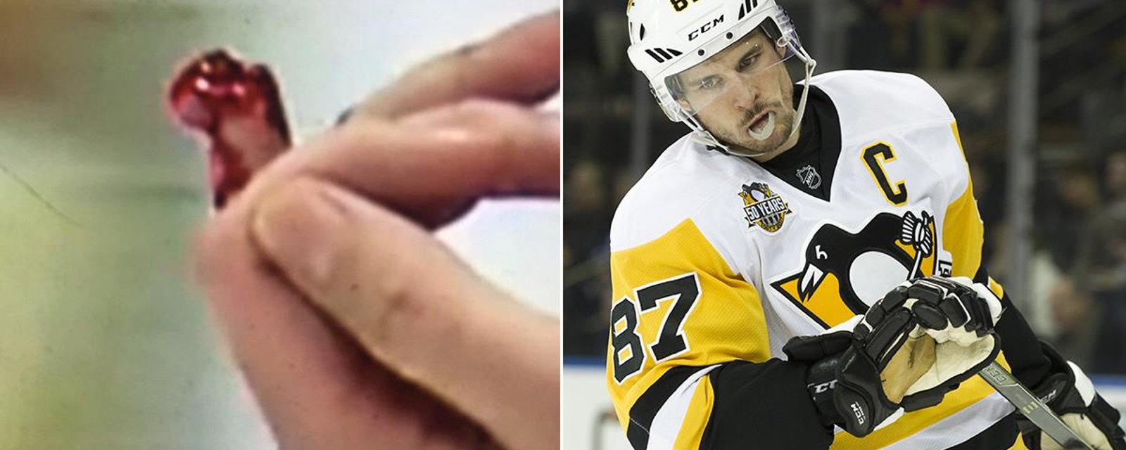 New update on Marc Methot's finger following the Crosby slash are terrible...