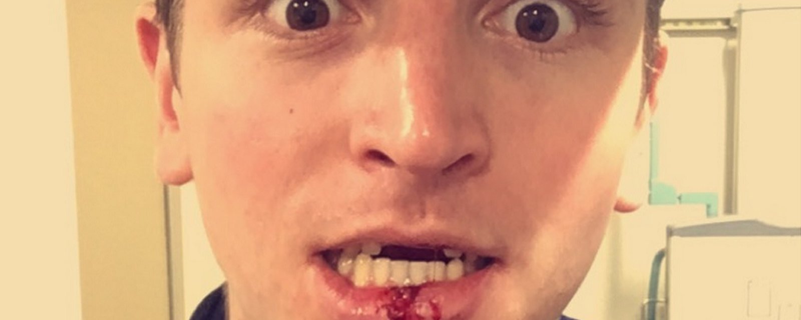 Jimmy Vesey loses his two front teeth, and finds them in a very painful location.