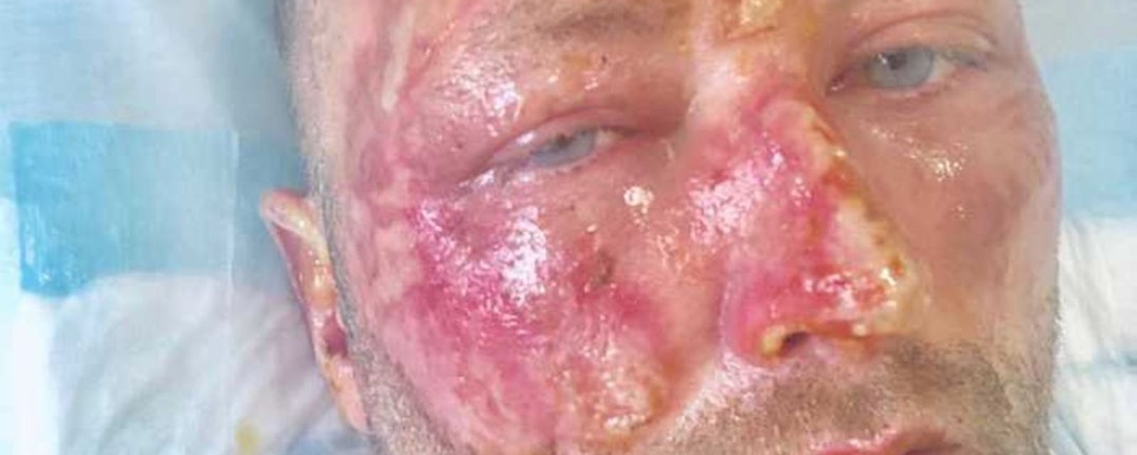 Former NHLer suffers atrocious burns to his face and upper body in accident 