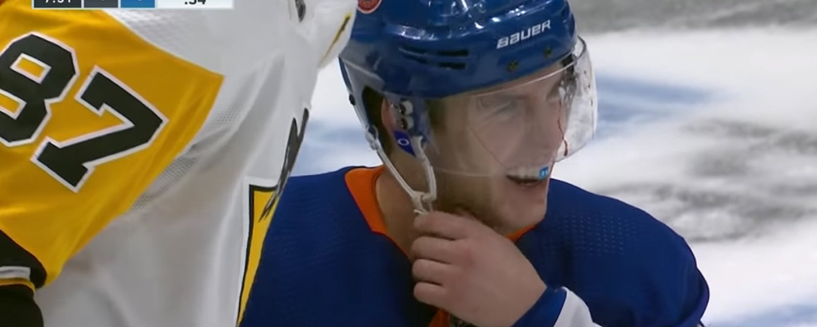 ICYMI: Hickey takes a Malkin slap shot to the head, gets busted wide open