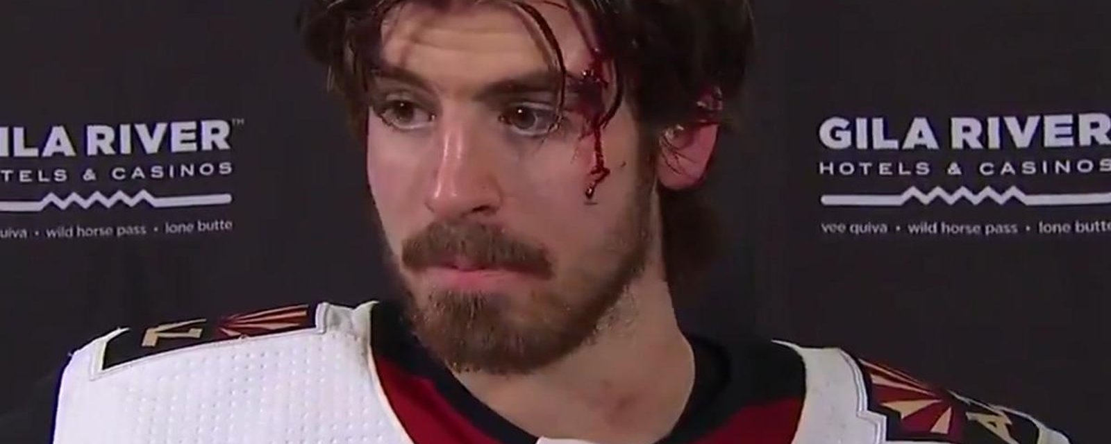 Garland gives post game interview while still bleeding from his face.