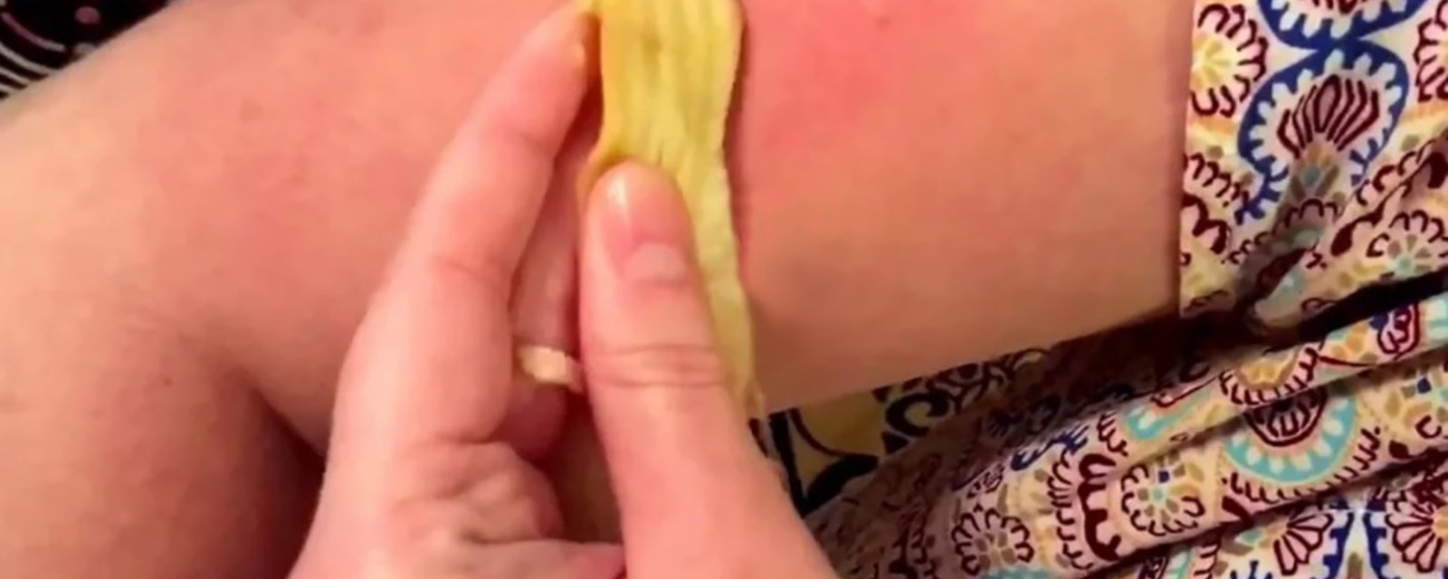 Elle frotte une pelure de banane sur sa peau...j'avais du mal à croire que le soulagement soit aussi rapide!