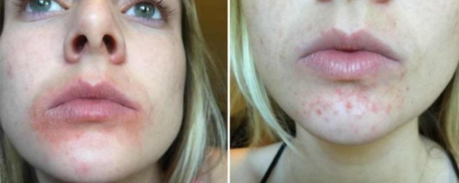 Une nouvelle marque de baume à lèvres cause de sérieux problèmes à plusieurs femmes