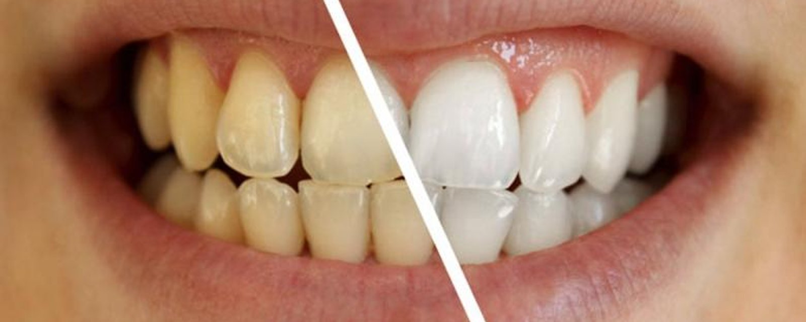 Comment blanchir vos dents naturellement ! Ce qui est conseillé et ce qui est à éviter!