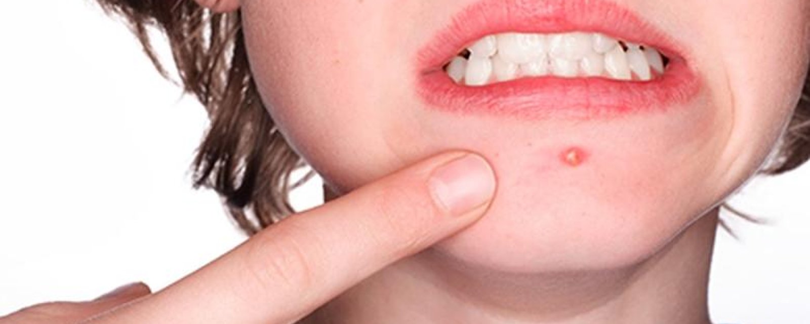 7 choses à éviter de faire si vous avez de l'acné. J'applique le numéro 1 dès maintenant!