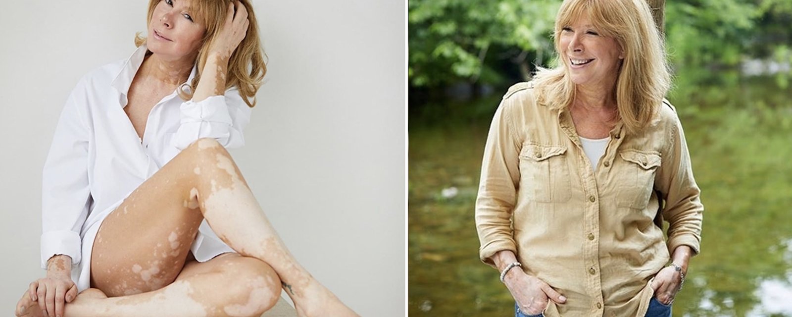 Chantal Lacroix se dévoile dans une nouvelle photo où elle assume son vitiligo et elle est rayonnante