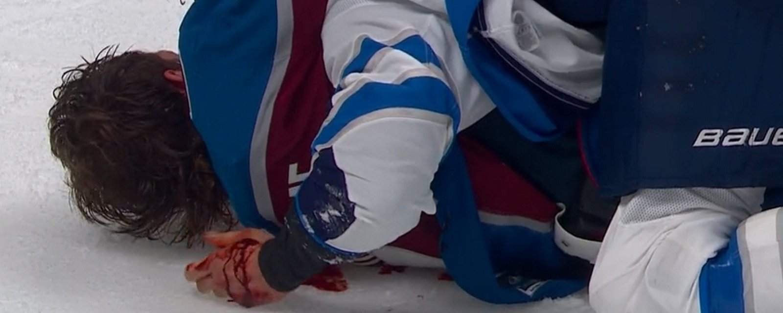Closer look at Brendan Dillon's injury after brawl in Game 3.