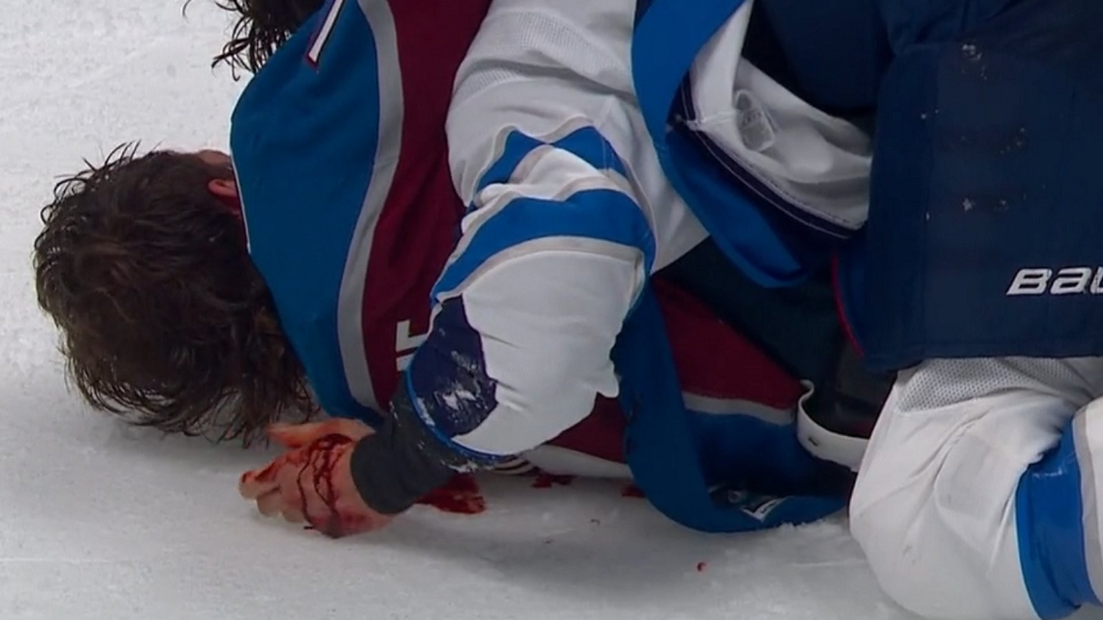 Closer look at Brendan Dillon's injury after brawl in Game 3.