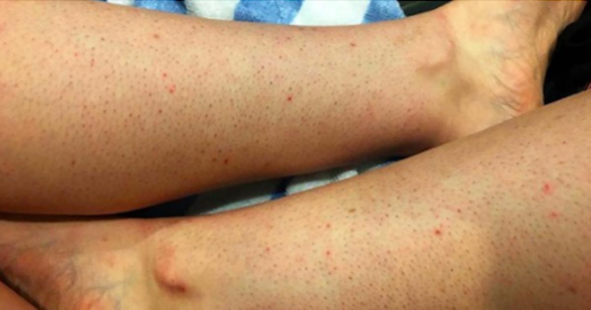 Quelles sont les causes de la « la peau de fraises » et comment s