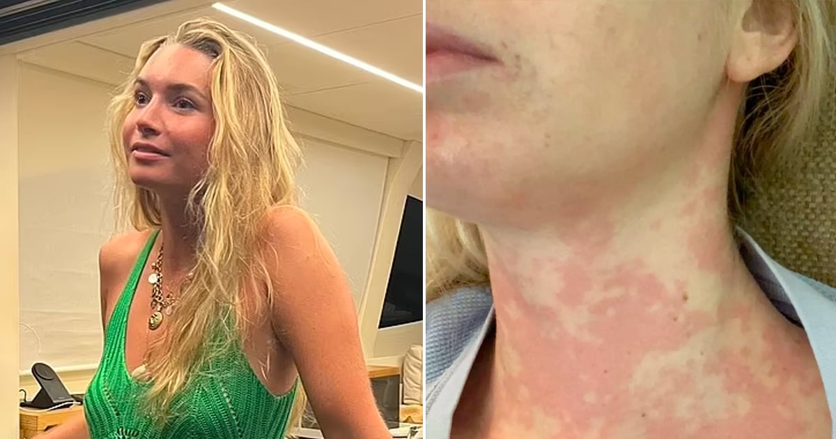 Une jeune femme souffre d'une rare condition alors qu'un baiser pour la tuer.