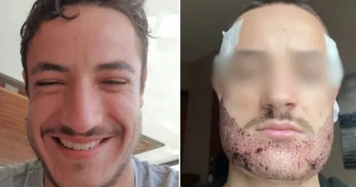 Un jeune homme met fin à ses jours à la suite d'une greffe de la barbe ratée 