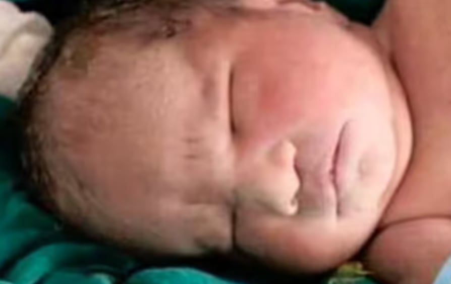 Un bébé «sirène» décède 15 minutes après sa naissance.
