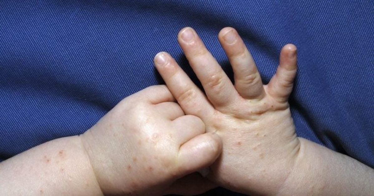 Une nouvelle maladie s’attaque principalement aux enfants