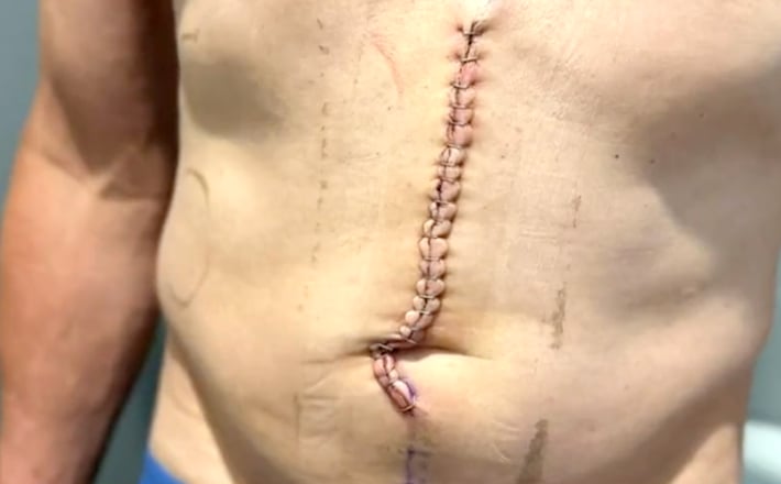 Il se retrouve avec 22 points de suture suite à un barbecue 