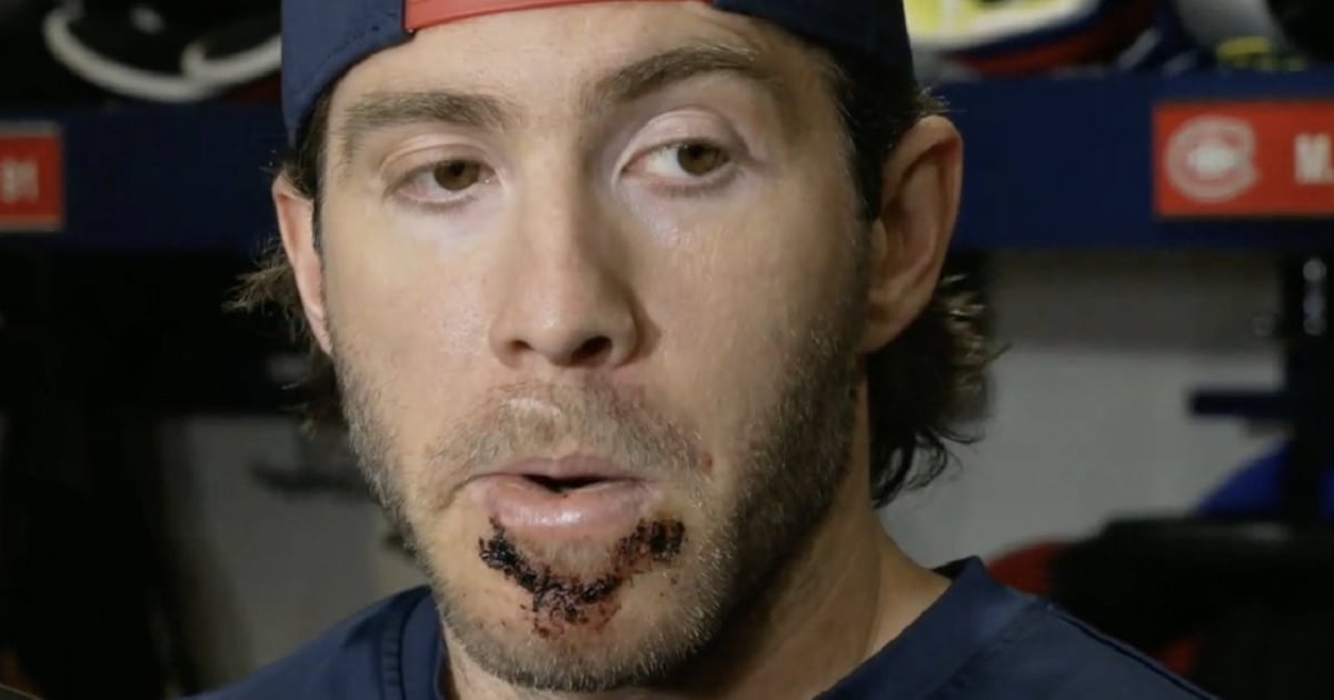 A gruesome-looking Mike Hoffman slams NHL Player Safety.