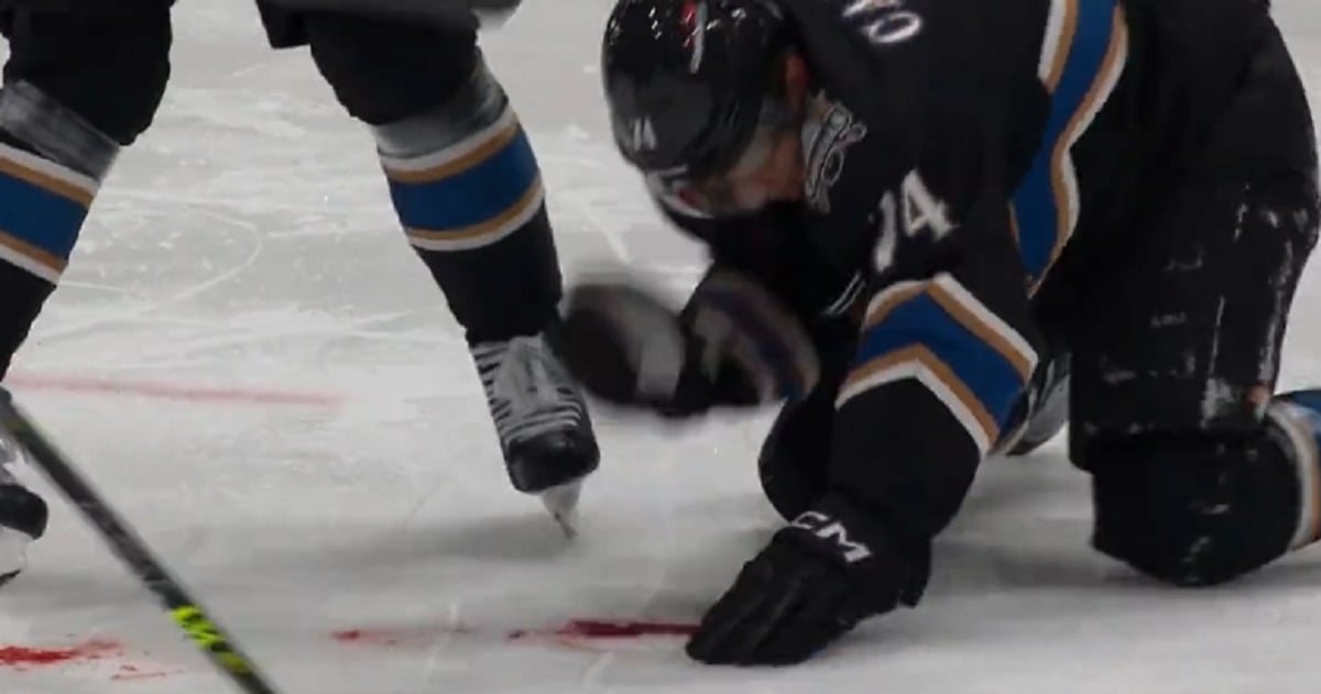 Shot to the face sends John Carlson to hospital.