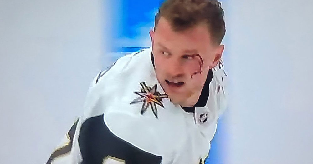 Eichel takes a shot to the face, leaves the game leaking badly all over the ice