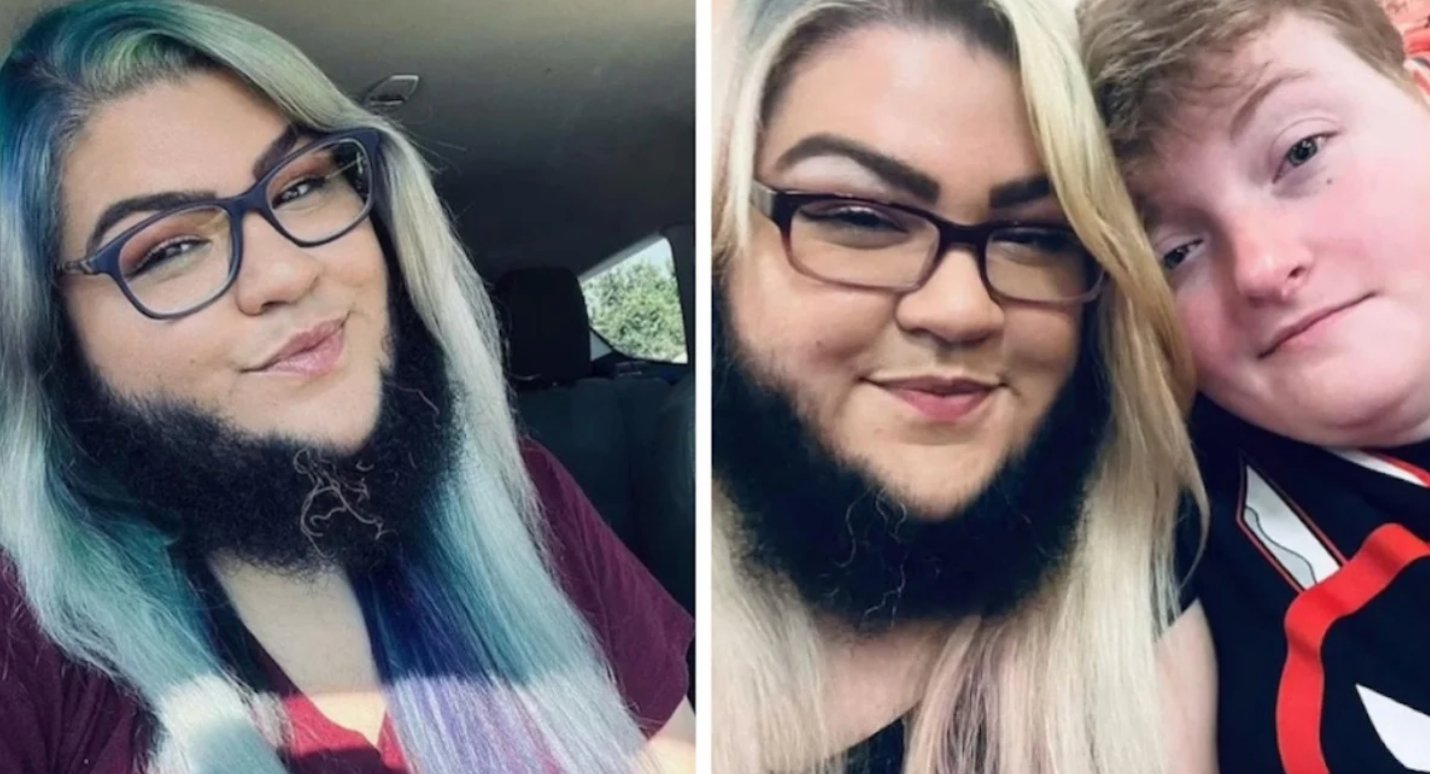 Une femme barbue se confie au sujet de son histoire d'amour.
